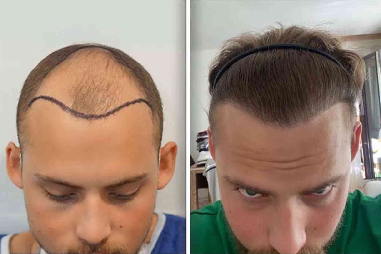 Hair Transplant Turkey